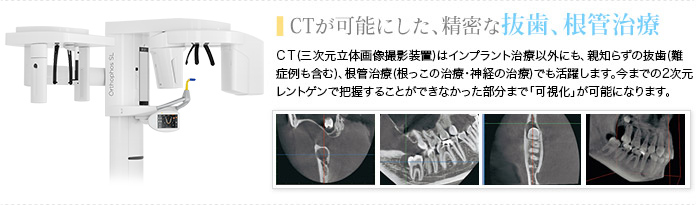 
CTが可能にした、精密な抜歯、根管治療