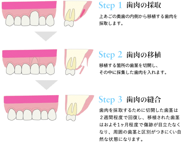上あごの奥歯の内側から移植する歯肉を採取します。移植する箇所の歯茎を切開し、その中に採集した歯肉を入れます。歯肉を採取するために切開した歯茎は２週間程度で元通りになり、移植された歯茎はおよそ1ヶ月程度で傷跡がなくなり、周囲の歯茎と区別がつかない自然な状態になります。