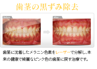 歯茎の黒ずみ除去　歯茎に沈着したメラニン色素をレーザーで分解し、本来の健康で綺麗なピンク色の歯茎に戻す治療です。
